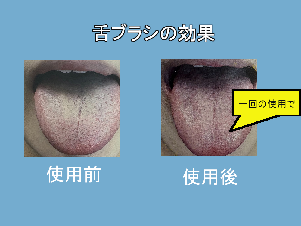 舌ブラシ使用前使用後